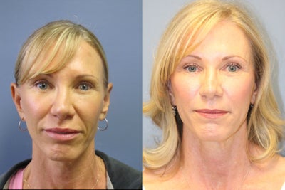 57 year old Blue Peel Following Lite Lift  - 	Women had sun damage skin loves the results from Blue Peel and her Lite Lift.