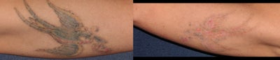 Laser Tattoo Removal with Picosure Laser - 75% improvement in tattoo pigment after just 2 picosure treatments of tough to treat tattoo colors. Could take up to 6-8 treatments with standard Q-switched lasers to achieve similar results.