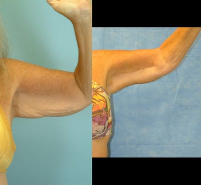 64 Year Old Female Treated for Bilateral Excess/Laxity Skin of Upper Arm - 
	64 Year Old Female Diagnosis: Bilateral Excess/Laxity Skin of Upper Arms Procedure: Bilateral Brachioplasty
