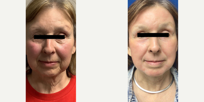 65-74 year old woman treated with Double Eyelid Surgery, QuickLift, CO2 Laser - Patient's concerns were wrinkles and droopy eyelids.