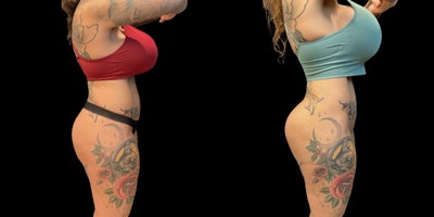 35-44 year old woman treated with Butt Implants - Patient recieved breast implant exchange; silicone breast implants.