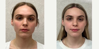 18-24 year old woman treated with Brow Bone Reduction, Brow Lift, Forehead Reduction - this is a young lady who under forehead reconstruction.
