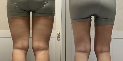 25-34 year old woman treated with Lipodissolve - Fat-dissolving injections to contour the thighs