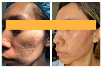 35-44 year old woman treated with Bellafill, MiXto Laser, Laser Resurfacing, CO2 Laser, Sculptra - Mixto fractional CO2 resurfacing was combined with subcision and Sculptra Filler and Bellafill to treat deep atrophic and rolling acne scars. Two treatments were performed, six months apart, and this is the patient one year after the first treatment.