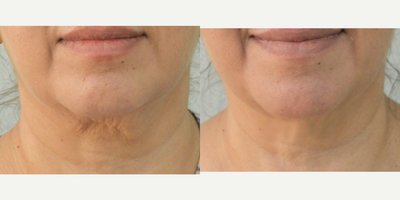 55-64 year old woman treated with Exilis - 59 years old female patient complains of loose wrinkled skin in relation to jaw line and neck. 5 sessions of exilis done for the neck and jaw region. Post exilis pictures taken after 5 sessions.