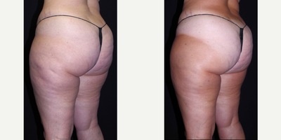 45-54 year old woman treated with Cellulaze - 45 year old female received Cellulaze to the outer thighs; photos depict the patient's results 11 weeks post-op.