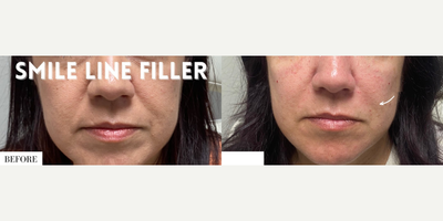 Woman treated with Dermal Fillers - Woman treated with Dermal Fillers