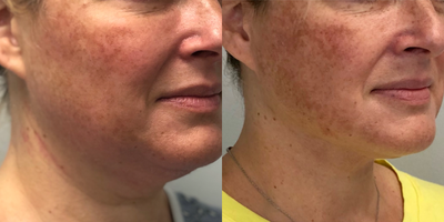 45-54 year old woman treated with FaceTite - Patient treated with FaceTite and liposuction