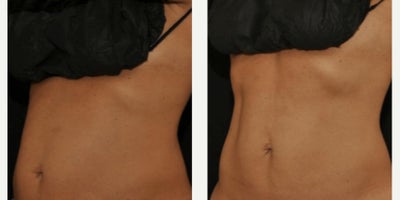 35-44 year old woman treated with Evolve - Patient finished series of body sculpting with Evolve Transform. Treated by Alyssa G.