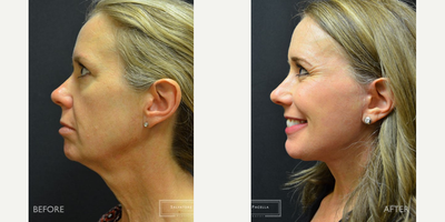 51 year old woman treated with Facial Fat Transfer, Brow Lift - This 51 year-old female was unhappy with the appearance of her face and brow. Being very athletic, the additional loss of natural fat was very troubling to her. Restoration of this fat volume was performed with precise fat transfer to the cheeks, jowls and facial folds. In addition, a deep plane facelift, neck lift and endoscopic browlift was utilized to resuspend the facial tissues to a more youthful position. Her results at 8 months show barely perceptible scars and beautiful contour.
