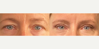 Woman treated with Brow Lift - This lady wanted a little change with her eyes and that's what we gave her! A subtle Brow lift and Upper blepharoplasty.
