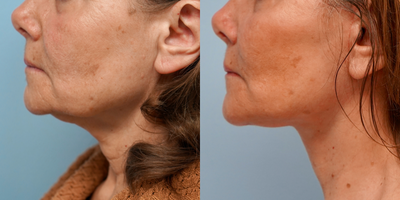 55-64 year old woman treated with Facelift - Face and neck lift with facial lipofilling