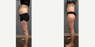 35 year old woman treated with UltraShape Power - 35 year old woman treated with 3 sessions of UltraShape Power