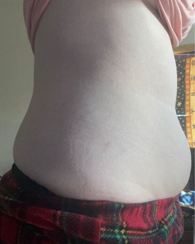 Lipodissolve Reviews | Was it Worth It? | RealSelf