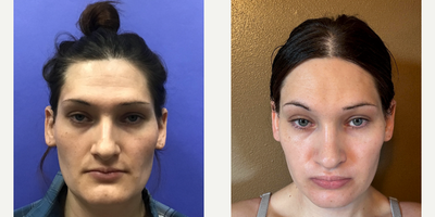 Patient treated with Facial Feminization Surgery, Transgender Facial Feminization Surgery - 25 to 34 year-old female patient is 3 months post-op from Facial Feminization surgery. Her procedures included: Modified Coronal Forehead Lift, Orbital Bony Contour, Chin Reduction and Contour, and Septorhinoplasty (Closed) with Cartilage Grafts and Weirs.