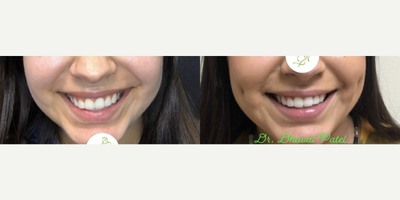 22 year old woman treated with Dimple Surgery - 22 year old woman treated with Bilateral Dimpleplasty