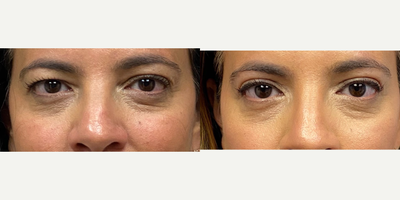 45-54 year old woman treated with Eyelid Surgery - Three weeks after an upper eyelid blepharoplasty.