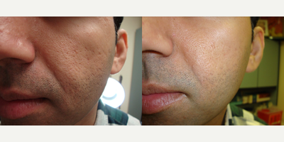 Man treated with Subcision - Fieldsubcision forice pick scars