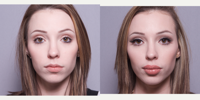 18-24 year old woman treated with Juvederm - 18-24 year old woman treated with Juvederm in her lips