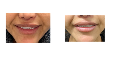 35-44 year old woman treated with Lip Repositioning - Lip lift revision/repositioning