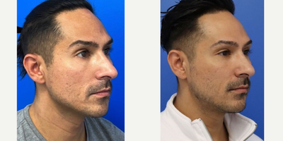 25-34 year old woman treated with Microneedling, Skin Rejuvenation - After 4 sessions of PRP with scar subcisions by PA Steve.