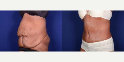 Body Lift - Body Lift
