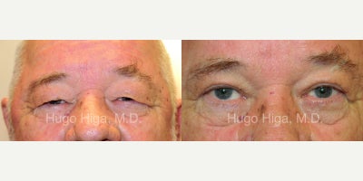 Eyelid Surgery - Eyelid Surgery