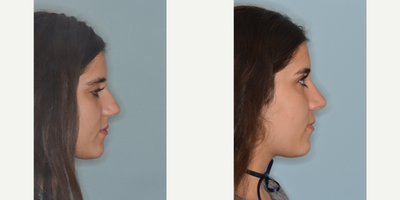18-24 year old woman treated with Rhinoplasty - Before and after primary rhinoplasty for a patient who desired to reduce the length of her profile and refine her tip. She desired to reduce her hump and the droopy appearance of her tip on the profile view. Primary rhinoplasty techniques included hump reduction, bilateral osteotomies, bilateral spreader grafts, septal extension graft, and alar rim grafts. The columella was lengthened to improve the tip angle and the relationship between the alae and the columella. Prior to surgery she had what is referred to as a hidden columella where the nostrils hang below the level of the columella on the profile view. By lengthening the columella, the relation of the columella and the nostrils is improved which also addresses her concern of a droopy tip.