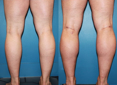Man treated with Calf Implant - Man treated with Calf Implant