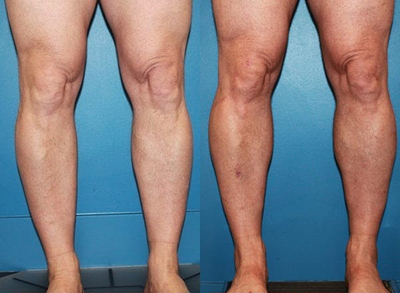 Man treated with Calf Implant - Man treated with Calf Implant