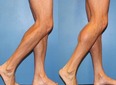 Man treated with Calf Implant - Man treated with Calf Implant