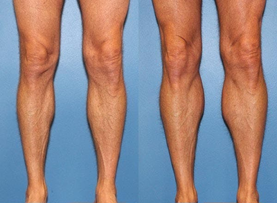 Man treated with Calf Implant - Man treated with Calf Implant