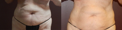 65-74 year old woman treated with Skin Tightening - 73 y.o. woman used ultraslim for weight loss, skin tightening and body contouring. 6 treatments.