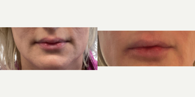 35-44 year old woman treated with Silicone Injection Removal - Patient underwent two rounds of unknown injections about 15 years ago. After noticing some unevenness and lumps on her lips she decided to consult with a board-certified plastic surgeon. After the silicone was removed from her lips patient received one syringe of filler to help give her shape and definition back to her lips 6 months post op her removal procedure. She is now shown 13 months post op.