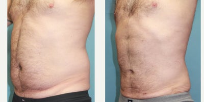 45-54 year old man treated with Liposuction - power assisted liposuction of abdomen and flanks