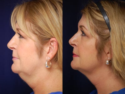 45-54 year old woman treated with Kybella - Patient has dramatic improvement in her chin and jowl fullness, after two treatments with Kybella.