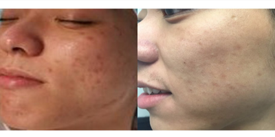 25-34 year old man treated with Microdermabrasion - 6 Microdermabrasion Treatments