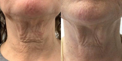 65-74 year old woman treated with Sofwave - 9 months after undergoing ultherapy and Sofwave done together