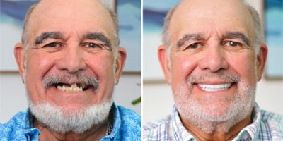 55-64 year old man treated with All-on-4 Dental Implants - You can get permanent, lasting teeth in 24 hours at Nuvia. Avoid waiting up to 10+ months for final teeth like traditional methods require.