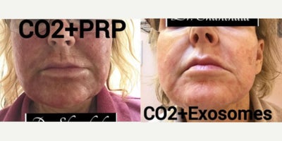 Woman treated with UltraClear Laser - Woman treated with UltraClear Laser