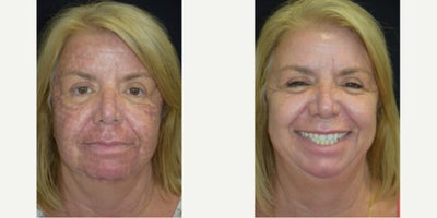 Woman treated with UltraClear Laser - Woman treated with UltraClear Laser