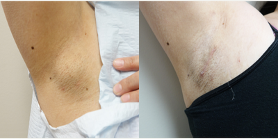 Lipoma Removal - Lipoma was removed in the office under local anesthesia. Patient can now wear sleeveless tops without worrying about lipoma showing