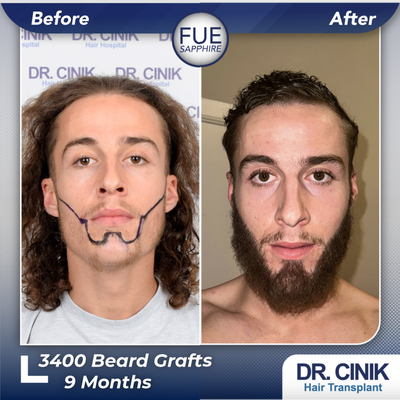 25-34 year old man treated with Beard Transplant - 3400 grafts