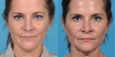 25-34 year old woman treated with Collagen Injection/Bellafill Collagen with PMMA - Liquid facelift with Bellafill: Collagen with PMMA 5 year filler