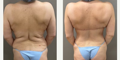 25-34 year old woman treated with Back Lift - 32 yo s/p back lift performed in our on site AAAA certified operating suite