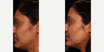 Acne Scars Combination Treatment with Subcision, CO2 Laser and TCA Cross by Dr. Qazi - Acne Scars Combination Treatment with Subcision, CO2 Laser and TCA Cross