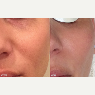 35-44 year old woman treated with Pico Genesis - Pico Genesis for pores.