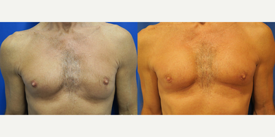 Man treated with Pec Implants - Man treated with Pec Implants