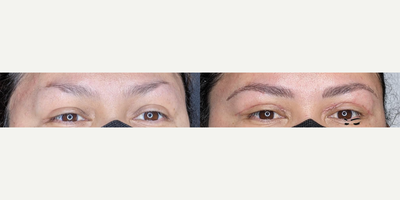 Woman treated with Microblading - Woman treated with Microblading. Patient is shown before and after the brows healed.