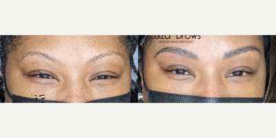 Woman treated with Microblading - Woman treated with Microblading. Patient is shown before and after touch up.